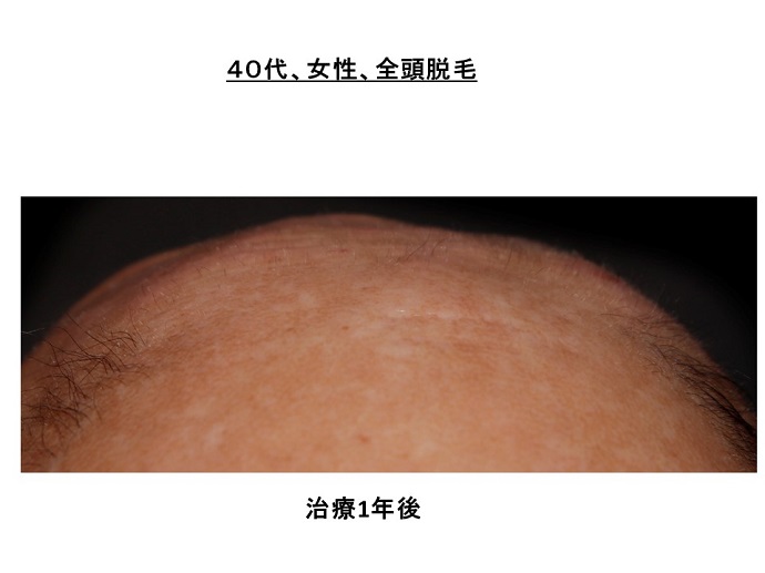 円形脱毛症　病院